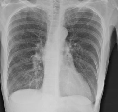 1. Chronic obstructive pulmonary diseases