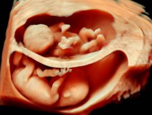 3D ultrasound multiple pregnancy