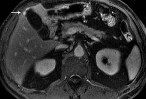 Adenomyomatosis of the gallbladder on MRI
