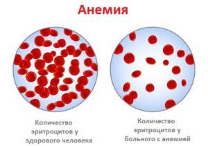 Anemia.jpg