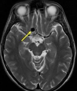 Aneurysmal dilatation of cerebral vessels on an M-scan