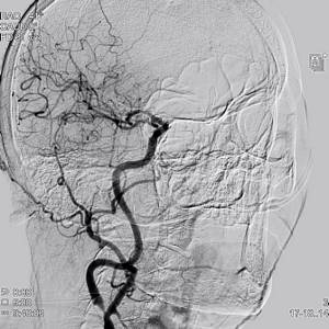 Angiography of the carotid arteries - narrowing of the internal carotid artery