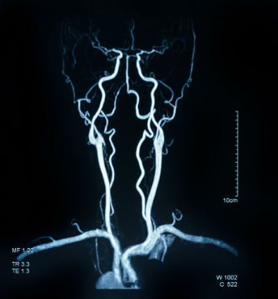 vascular angiography