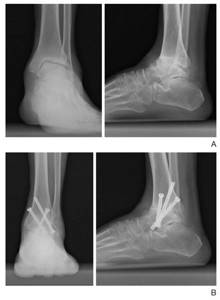 Arthrodesis of the ankle joint