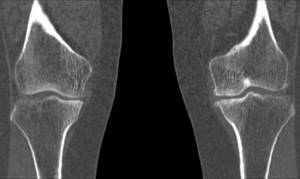 Arthrosis of the knee joint photo tomography images