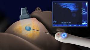 Ultrasound-guided breast biopsy