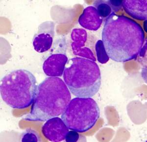 blast cells: relapse of leukemia