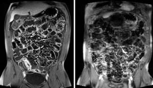 Crohn&#39;s disease on magnetic resonance imaging