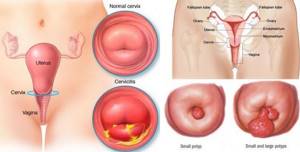 Cervicitis and cervical polyps