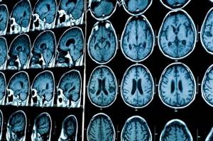 What is shown on MRI results of the brain?