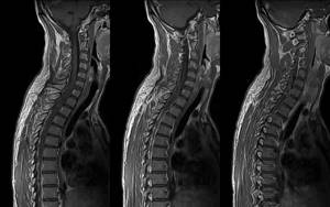 What does an MRI of the three parts of the spine show?