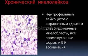 What is myeloid leukemia