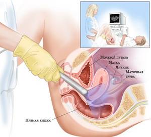 the sensor is inserted into the vagina (diagram)