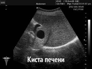 Kidney deformation