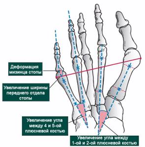 Deformation of the fifth and first toes