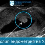 Diagnosis of uterine polyposis