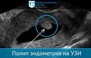 Diagnosis of uterine polyposis