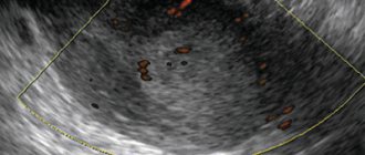 Diagnosis of uterine cancer