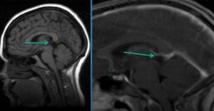 Pre- and post-contrast MRI images of the brain