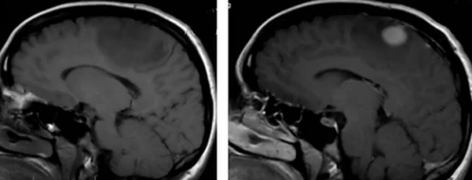Pre- and post-contrast images of a malignant brain tumor
