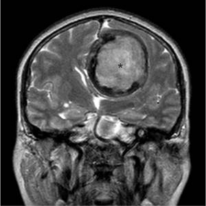 Benign tumor on MRI image