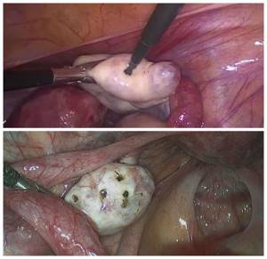 Ovarian Drilling