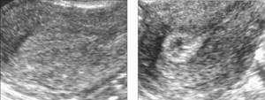 The echogenicity of the endometrium continues to increase from the periphery to the center, as a result of which the hypoechoic central fragment takes on a teardrop shape (the wide part in the area of ​​the uterine fundus narrows towards the cervix)
