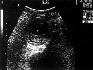 Ultrasound picture of an abdominal aortic aneurysm: 1-lumen of the aorta, 2-thrombotic masses filling the aneurysm, 3-area of ​​recanalization