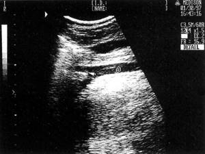 Sonographic picture of the abdominal aorta in the bifurcation area (marked with an arrow)