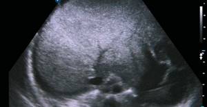 Sonographic picture of liver cirrhosis: the liver is significantly heterogeneously compacted, the vascular pattern is deformed, surrounded by a rim of ascitic fluid