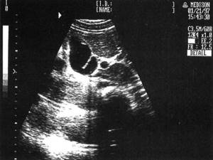 Sonographic picture of a deformed gallbladder