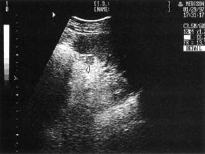 Sonographic picture of the accessory spleen