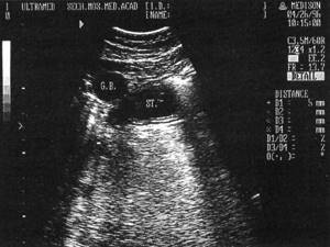 Sonographic picture of hypersection of the stomach, 5 layers of the wall are visible: St.-stomach, GB-gallbladder