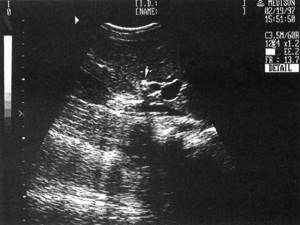 Echographic picture of choledocholithiasis (a stone giving an acoustic shadow is marked with an arrow)