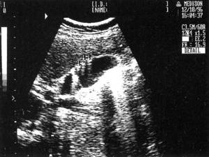 Sonographic picture of gallbladder cholesterosis (cholesterol polyps are marked with arrows)