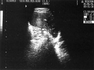 Sonographic picture of splenic infarction (marked with an arrow)