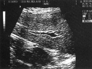 Sonographic image of the lobar hepatic duct