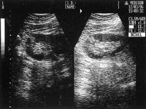 Sonographic picture of the left and right kidneys with small angiomyolipomas in the parenchyma