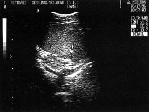 Sonographic picture of fine calcification of the liver (marked with an arrow)