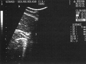 Sonographic picture of the unchanged abdominal esophagus: 1-liver, 2-abdominal esophagus, 3-heart, 4-diaphragm