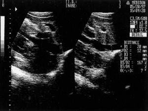 Sonographic picture of the inferior vena cava (on the left - with free breathing, on the right with straining)