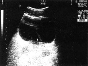 An echographic picture of a normal bladder (the release of a stream of urine from the mouth of the left ureter is indicated by an arrow