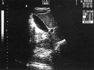 Sonographic picture of a normal gallbladder
