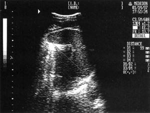 Sonographic picture of a normal spleen