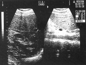 Sonographic picture of normal left and right lobes of the liver