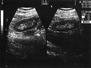Sonographic picture of normal right (RK) and left (LK) kidneys