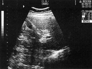 Sonographic picture of a focal form of fatty infiltration (marked with arrows)