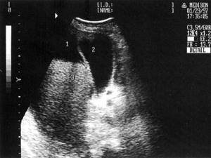 Sonographic picture of one of the variants of decompensated liver cirrhosis: 1-ascites, 2-gallbladder, 3-liver