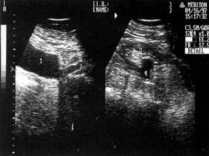 Sonographic picture of the kidney with dilatation of the pelvis and proximal ureter: 1-bladder, 2-ureter, 3-kidney, 4-pelvis