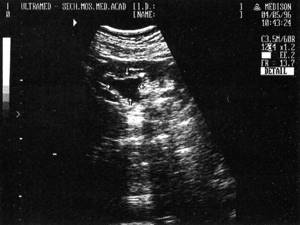 Sonographic picture of a kidney with a dilated pelvis (indicated by arrows)